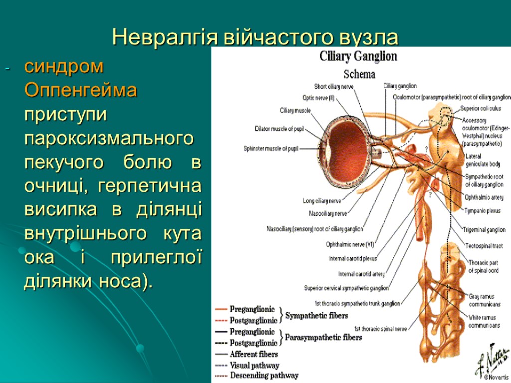 Невралгія війчастого вузла синдром Оппенгейма приступи пароксизмального пекучого болю в очниці, герпетична висипка в